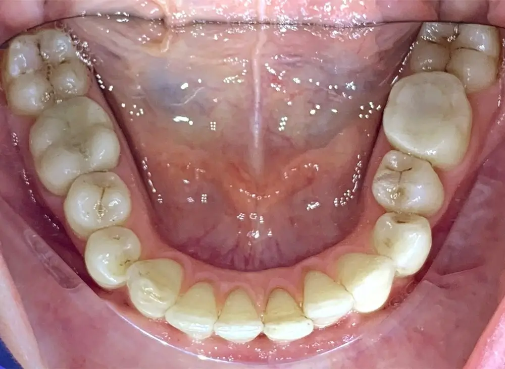 Дистальный прикус - Кейс 17 — нижняя челюсть до лечения