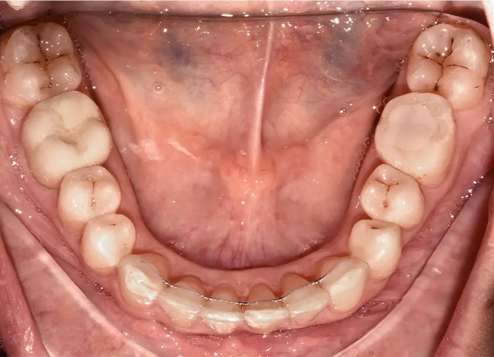 Дистальный прикус - Кейс 17 — нижняя челюсть после лечения