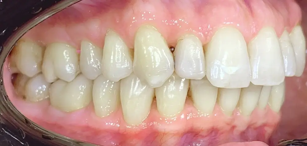 Дистальный прикус - Кейс 17 — боковой ракурс до лечения