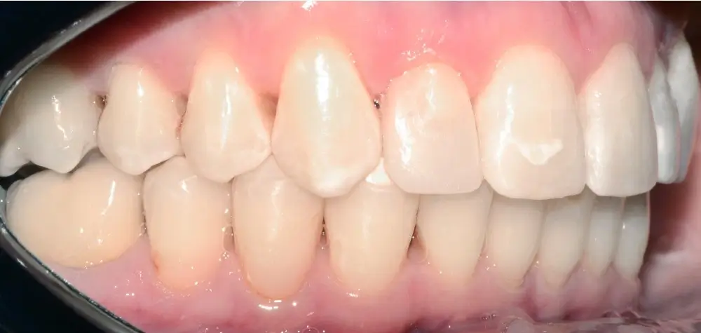 Дистальный прикус - Кейс 17 — боковой ракурс после лечения