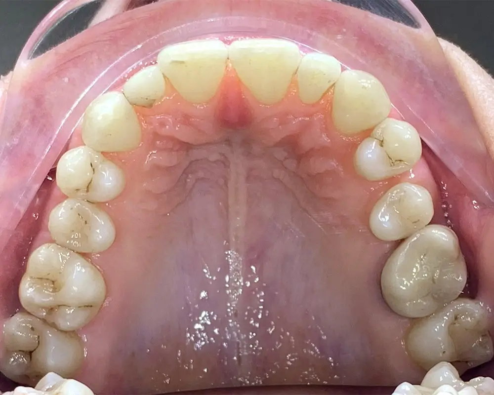 Дистальный прикус - Кейс 17 — верхняя челюсть до лечения