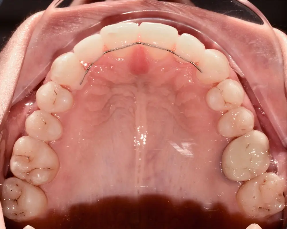 Дистальный прикус - Кейс 17 — верхняя челюсть после лечения