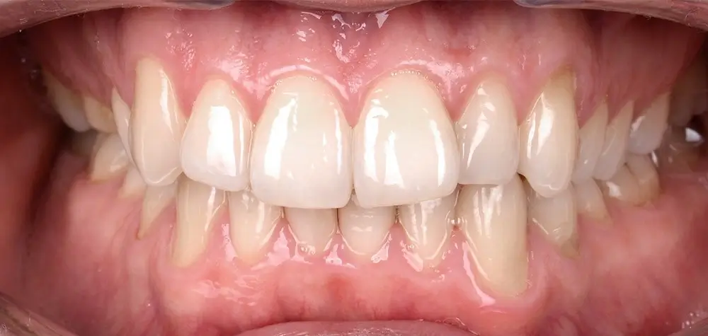 Дистальный прикус - Кейс 2 — вид спереди до лечения