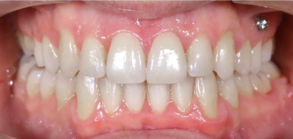 Дистальный прикус - Кейс 2 — вид спереди после лечения