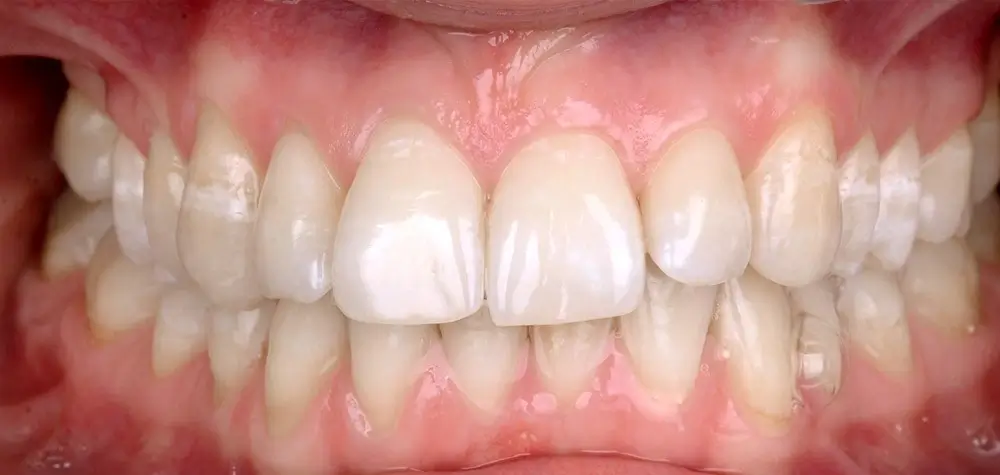 Дистальный прикус - Кейс 3 — вид спереди до лечения