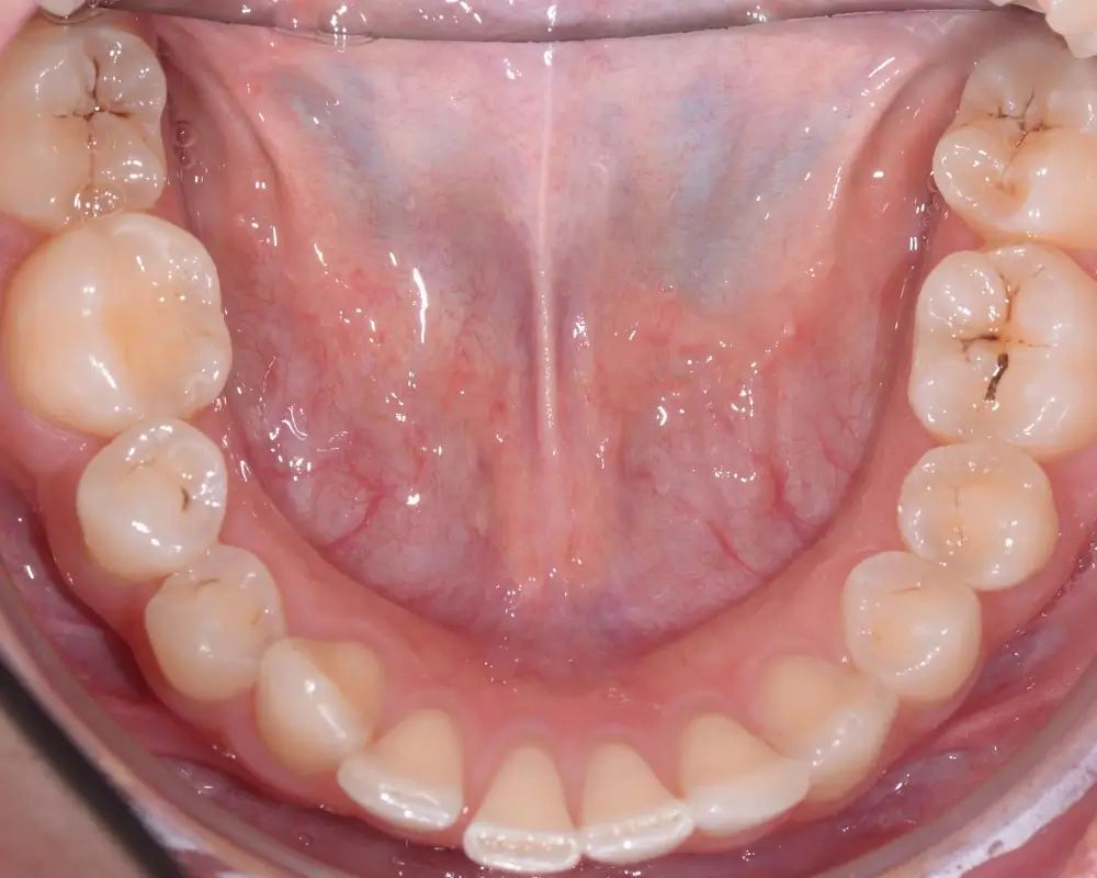 Дистальный прикус - Кейс 4 — нижняя челюсть до лечения