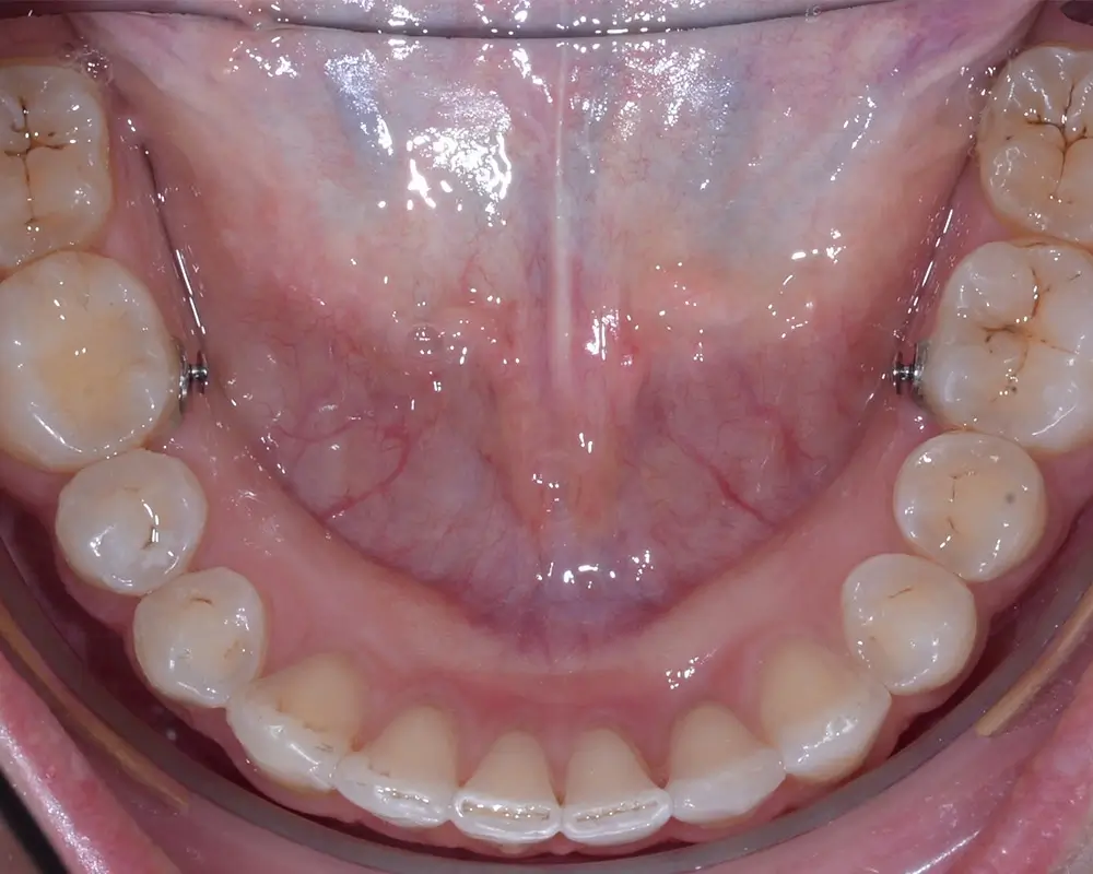 Дистальный прикус - Кейс 4 — нижняя челюсть после лечения