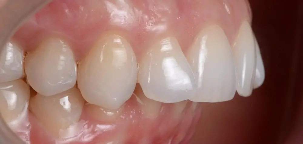 Дистальный прикус - Кейс 4 — боковой ракурс до лечения