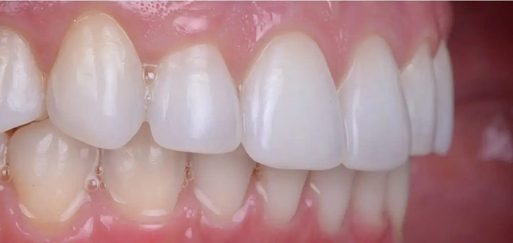 Дистальный прикус - Кейс 4 — боковой ракурс после лечения