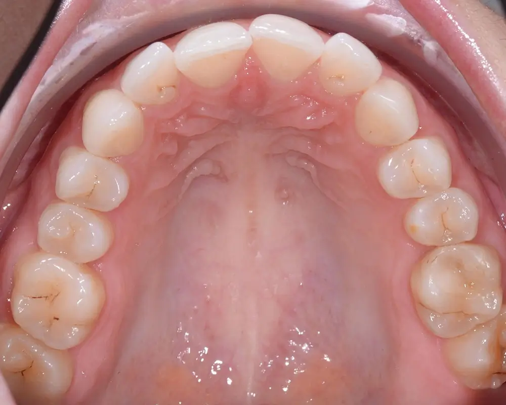 Дистальный прикус - Кейс 4 — верхняя челюсть до лечения