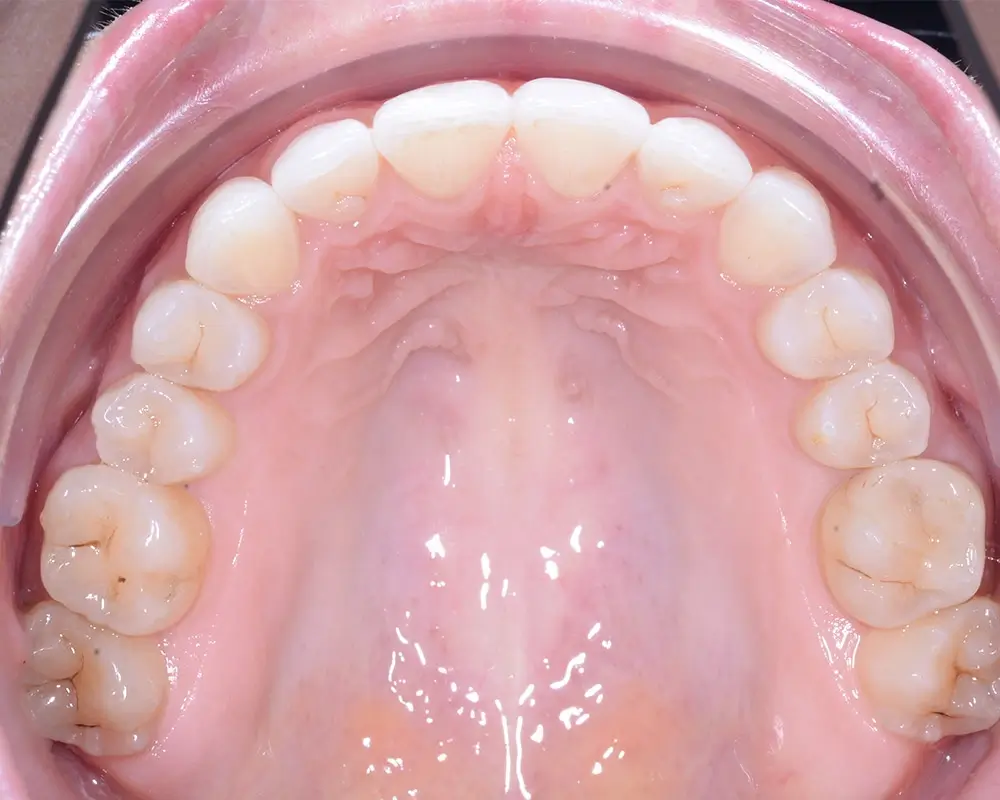 Дистальный прикус - Кейс 4 — верхняя челюсть после лечения