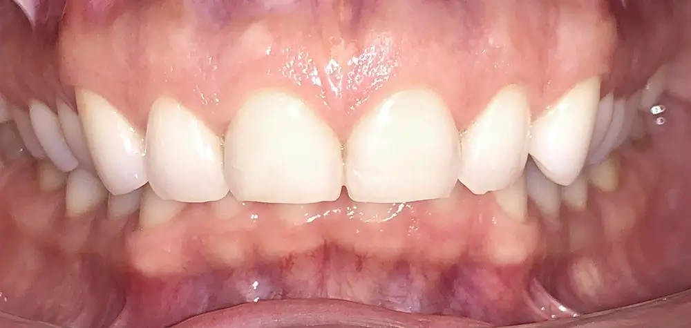 Дистальный прикус - Кейс 6 — вид спереди до лечения