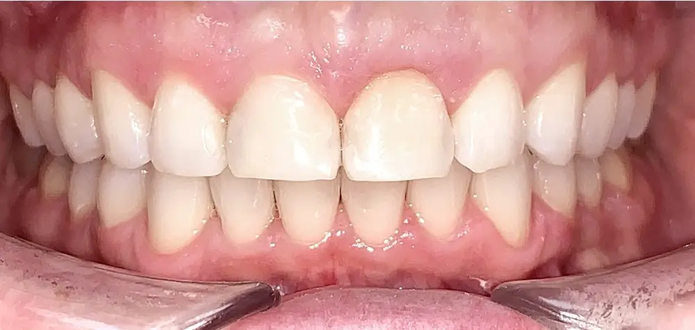 Дистальный прикус - Кейс 6 — вид спереди после лечения