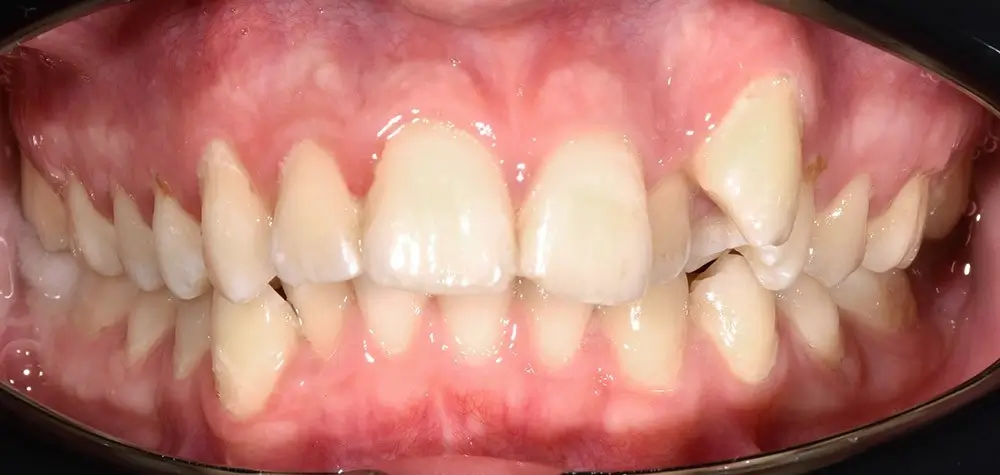 Дистальный прикус - Кейс 7 — вид спереди до лечения