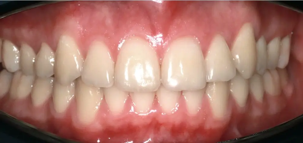 Дистальный прикус - Кейс 7 — вид спереди после лечения