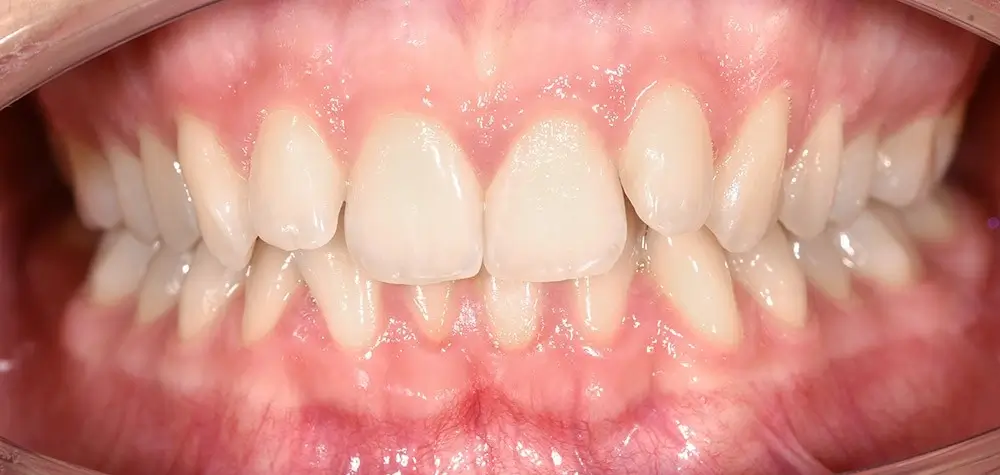 Дистальный прикус - Кейс 8 — вид спереди до лечения