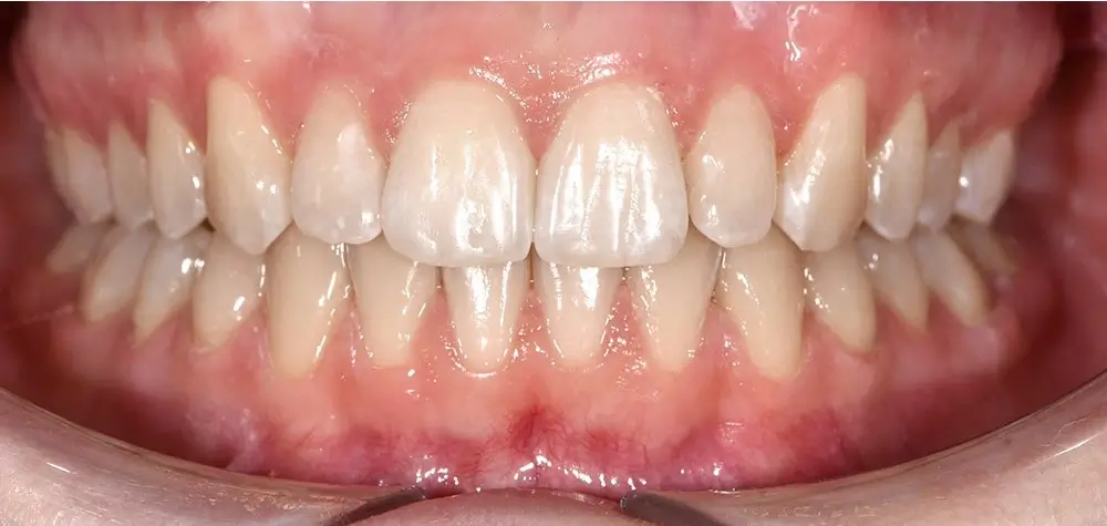 Дистальный прикус - Кейс 8 — вид спереди после лечения