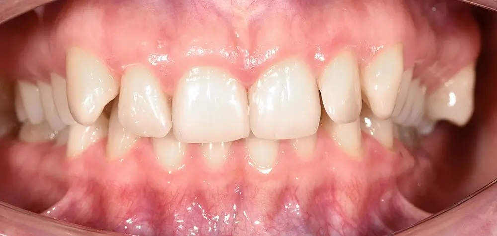 Дистальный прикус - Кейс 9 — вид спереди до лечения