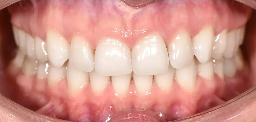 Дистальный прикус - Кейс 9 — вид спереди после лечения