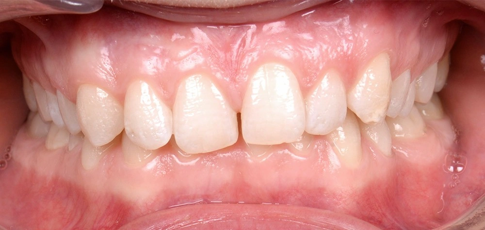 Глубокий прикус - Кейс 1 — фронтальный ракурс до лечения