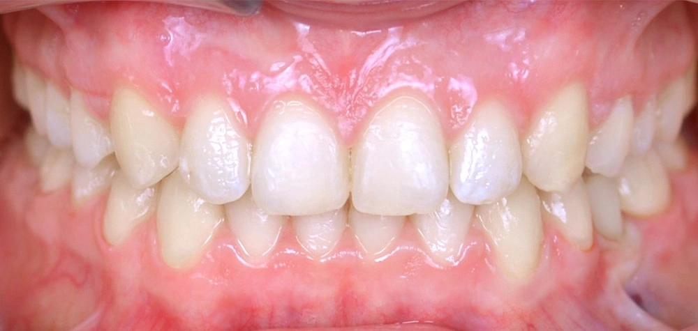 Глубокий прикус - Кейс 1 — фронтальный ракурс после лечения