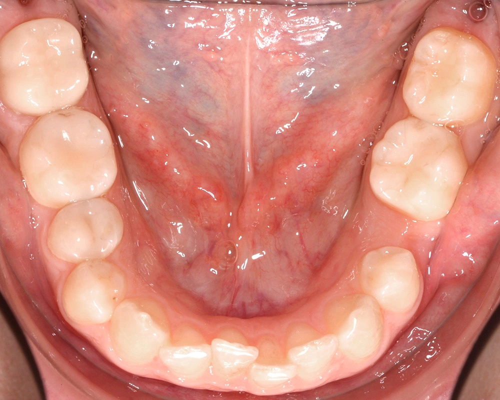 Глубокий прикус - Кейс 1 — нижняя челюсть до лечения
