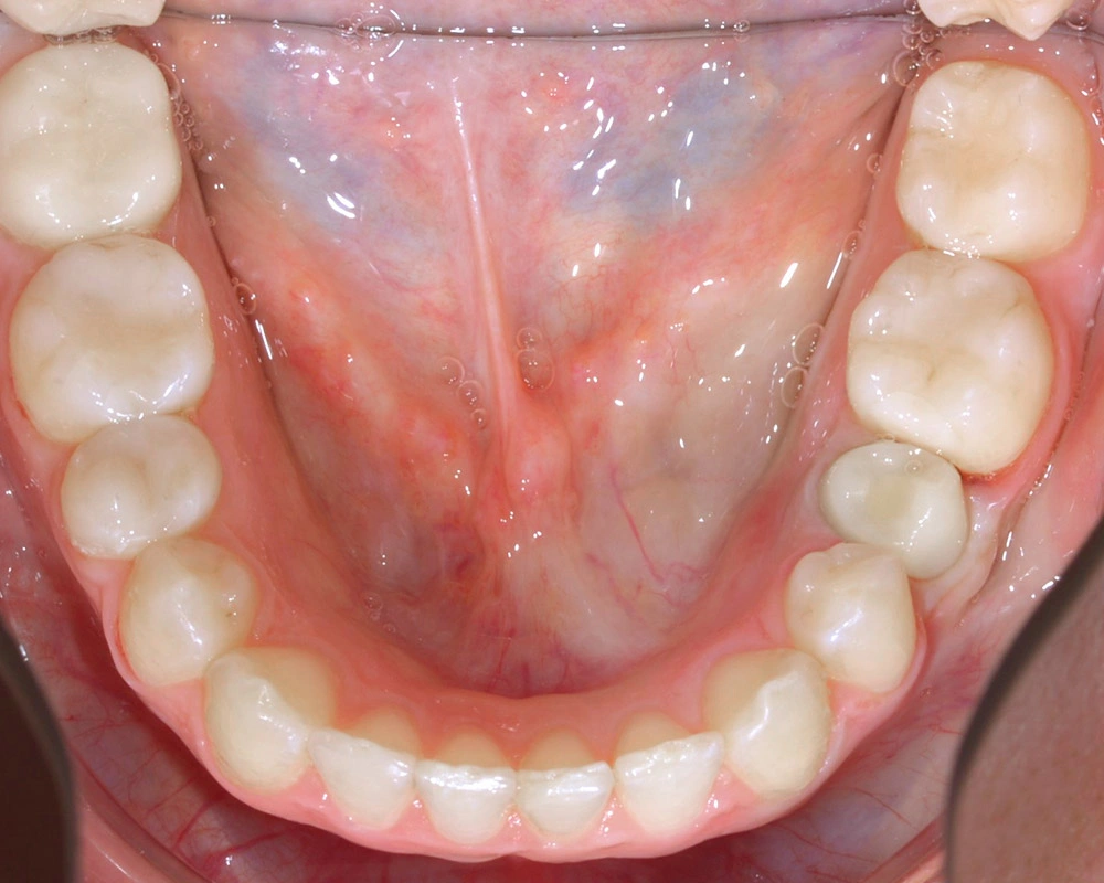 Глубоки й прикус - Кейс 1 — нижняя челюсть после лечения