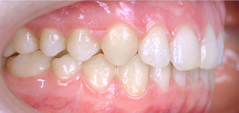 Глубокий прикус - Кейс 1 — боковой ракурс после лечения