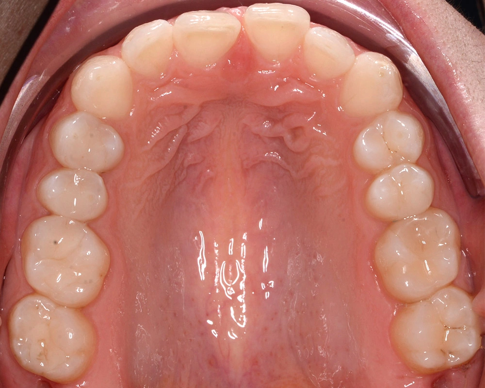 Глубокий прикус - Кейс 1 — верхняя челюсть до лечения