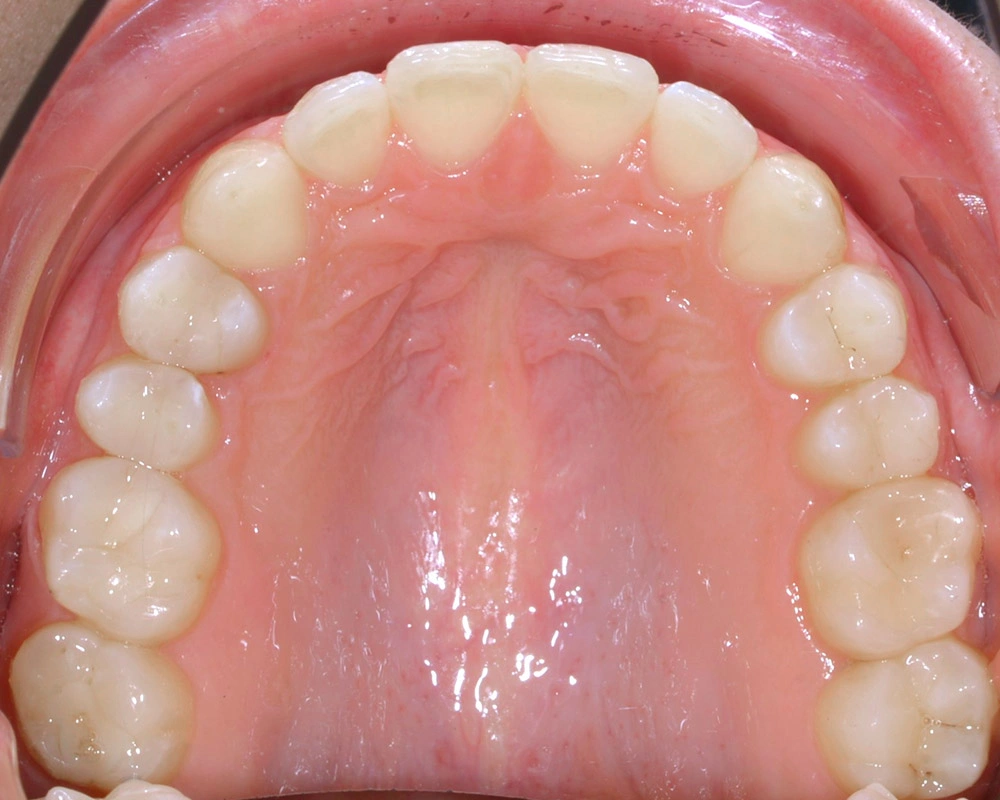 Глубокий прикус - Кейс 1 — верхняя челюсть после лечения