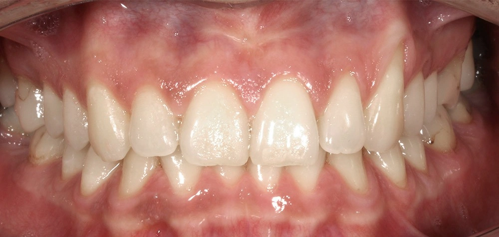 Глубокий прикус - Кейс 2 — фронтальный ракурс до лечения