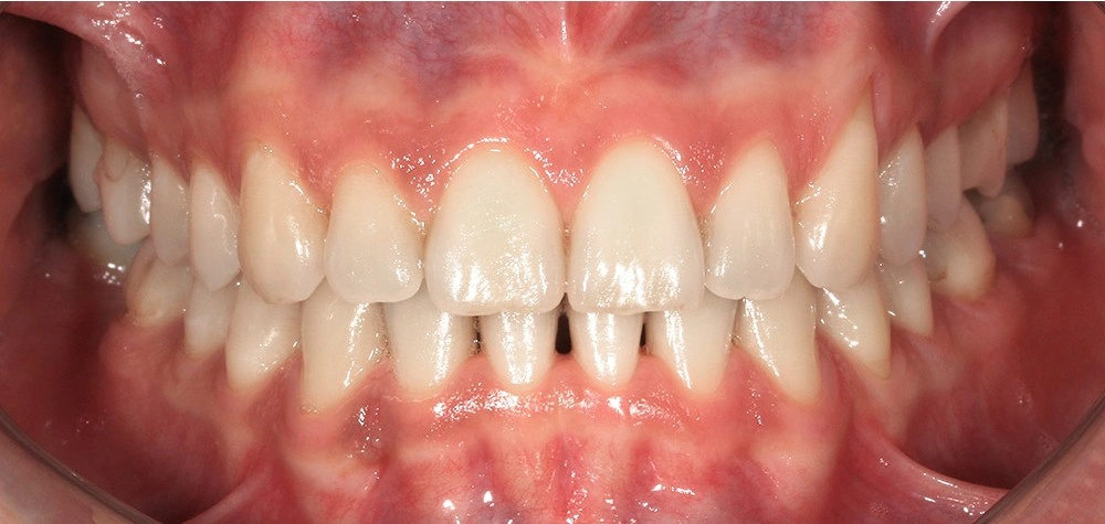 Глубокий прикус - Кейс 2 — фронтальный ракурс после лечения