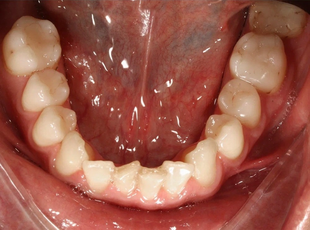 Глубокий прикус - Кейс 2 — нижняя челюсть до лечения