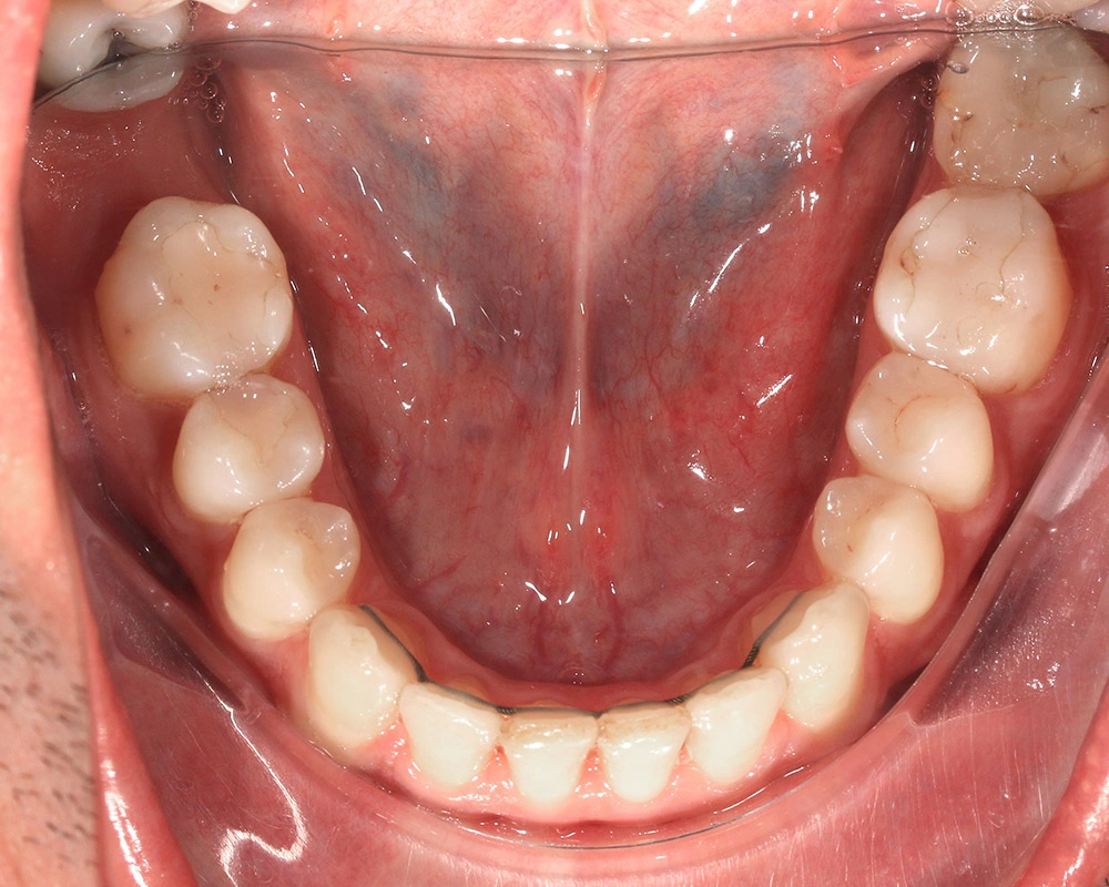 Глубокий прикус - Кейс 2 — нижняя челюсть после лечения