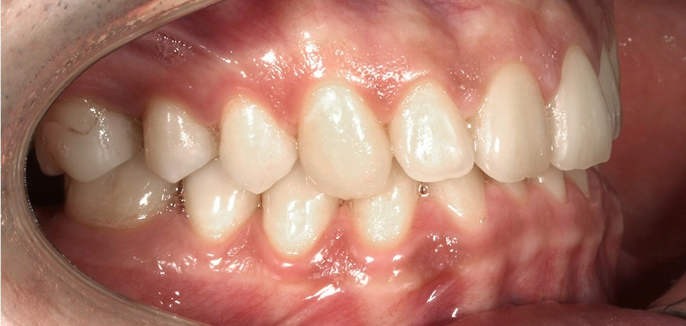 Глубокий прикус - Кейс 2 — боковой ракурс до лечения