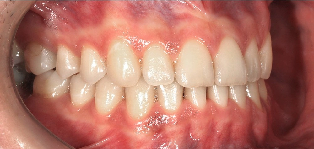 Глубокий прикус - Кейс 2 — боковой ракурс после лечения