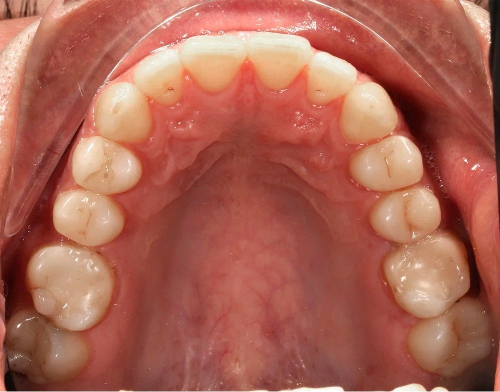 Глубокий прикус - Кейс 2 — верхняя челюсть до лечения