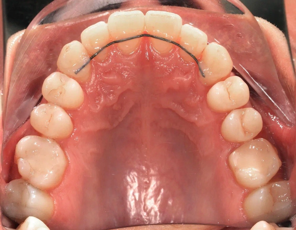Глубокий прикус - Кейс 2 — верхняя челюсть после лечения