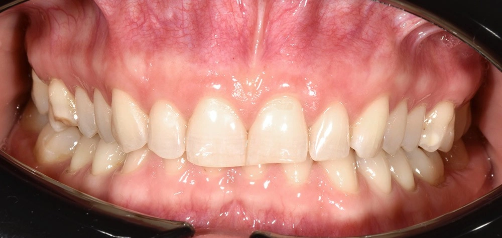 Глубокий прикус - Кейс 3 — фронтальный ракурс до лечения