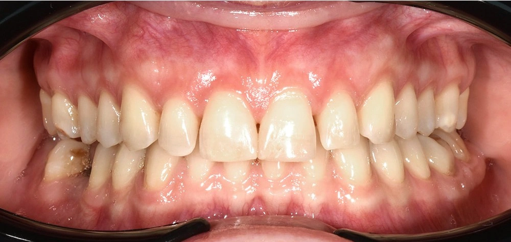 Глубокий прикус - Кейс 3 — фронтальный ракурс после лечения