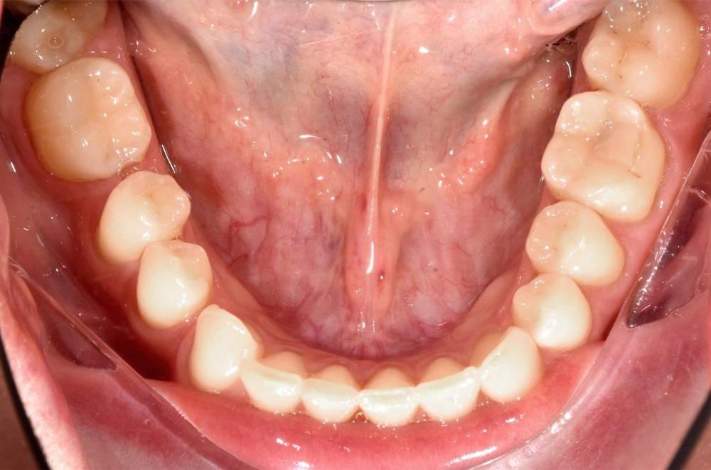 Глубокий прикус - Кейс 3 — нижняя челюсть до лечения