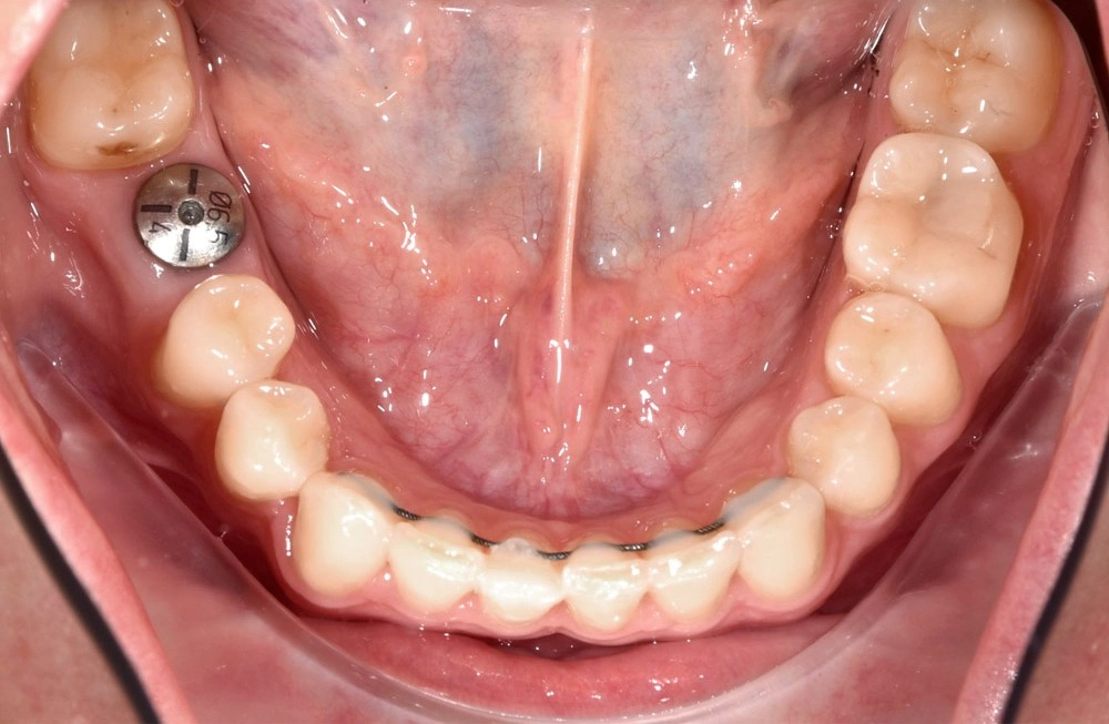 Глубокий прикус - Кейс 3 — нижняя челюсть после лечения