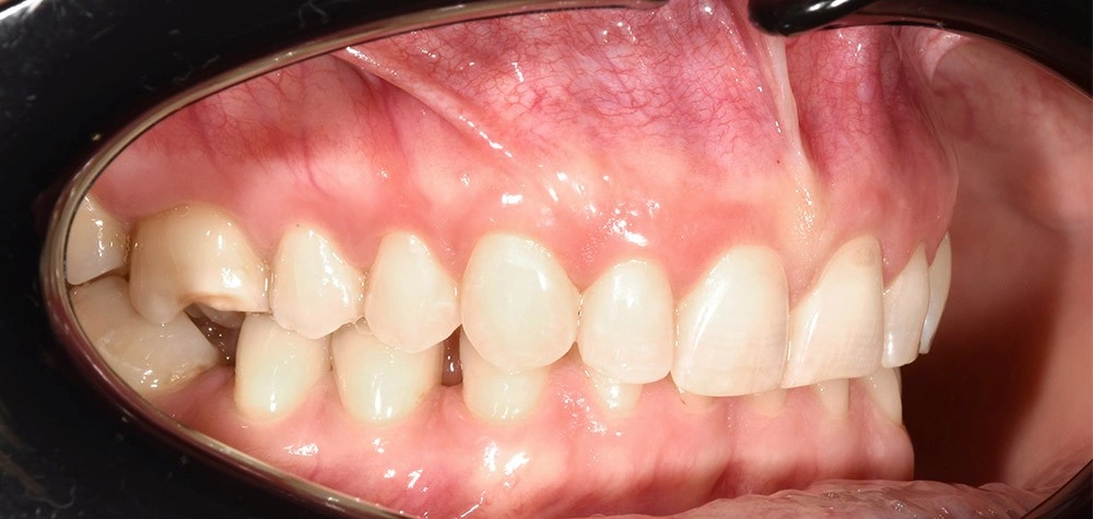 Глубокий прикус - Кейс 3 — боковой ракурс до лечения