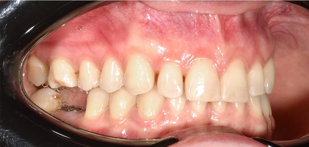 Глубокий прикус - Кейс 3 — боковой ракурс после лечения