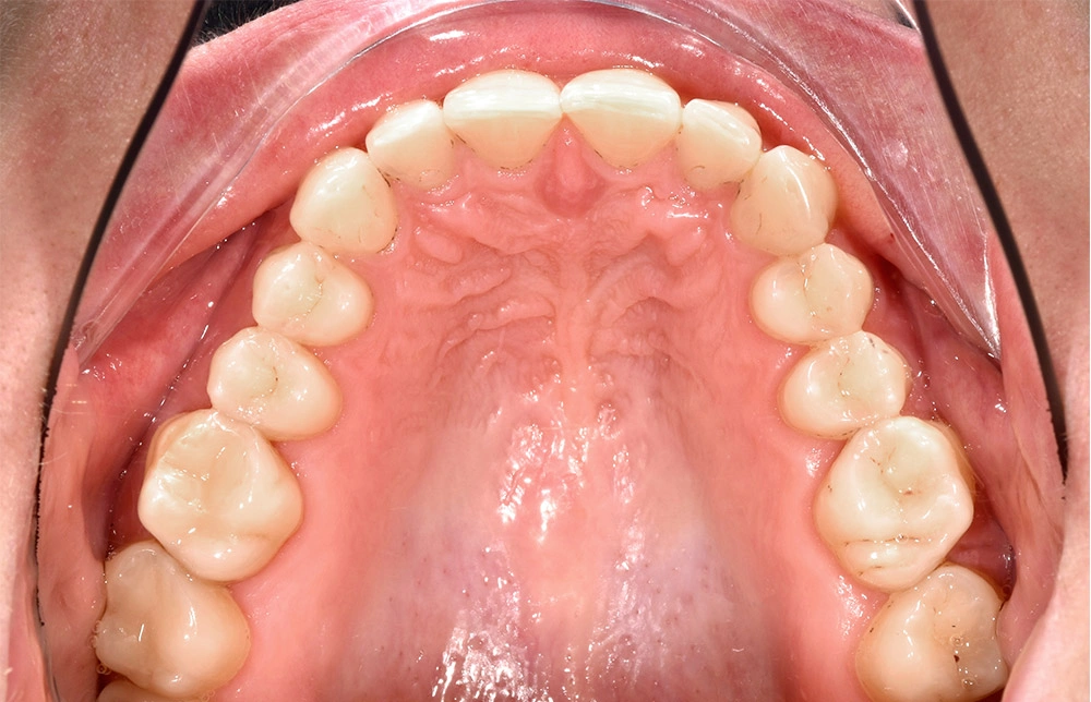 Глубокий прикус - Кейс 3 — верхняя челюсть до лечения