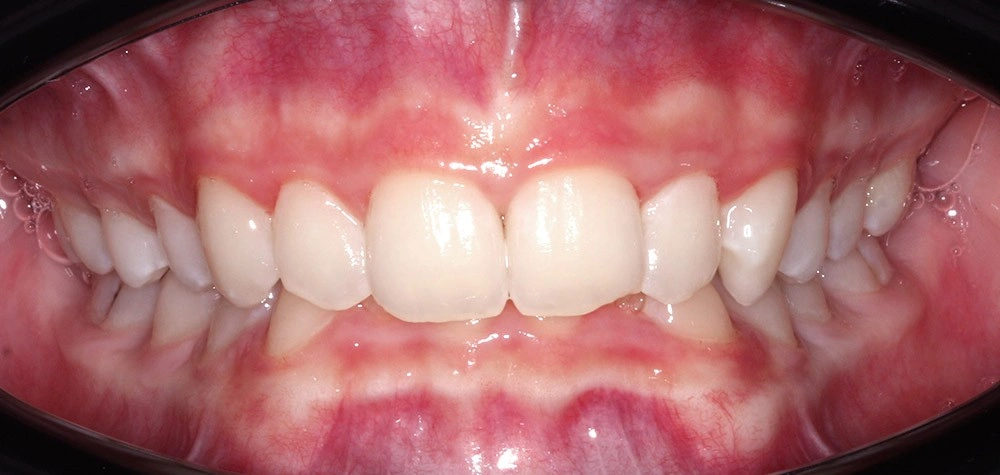 Глубокий прикус - Кейс 4 — фронтальный ракурс до лечения