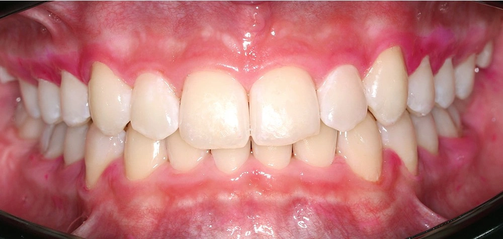 Глубокий прикус - Кейс 4 — фронтальный ракурс после лечения