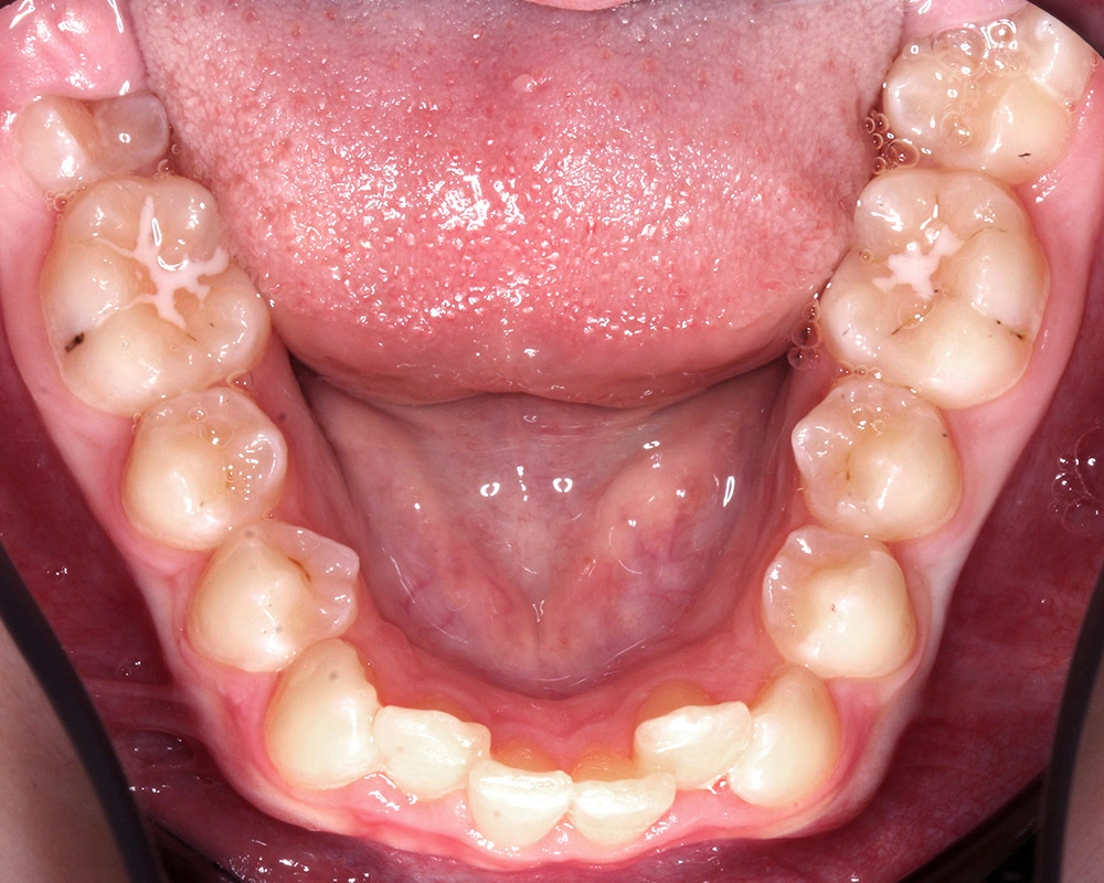 Глубокий прикус - Кейс 4 — нижняя челюсть до лечения