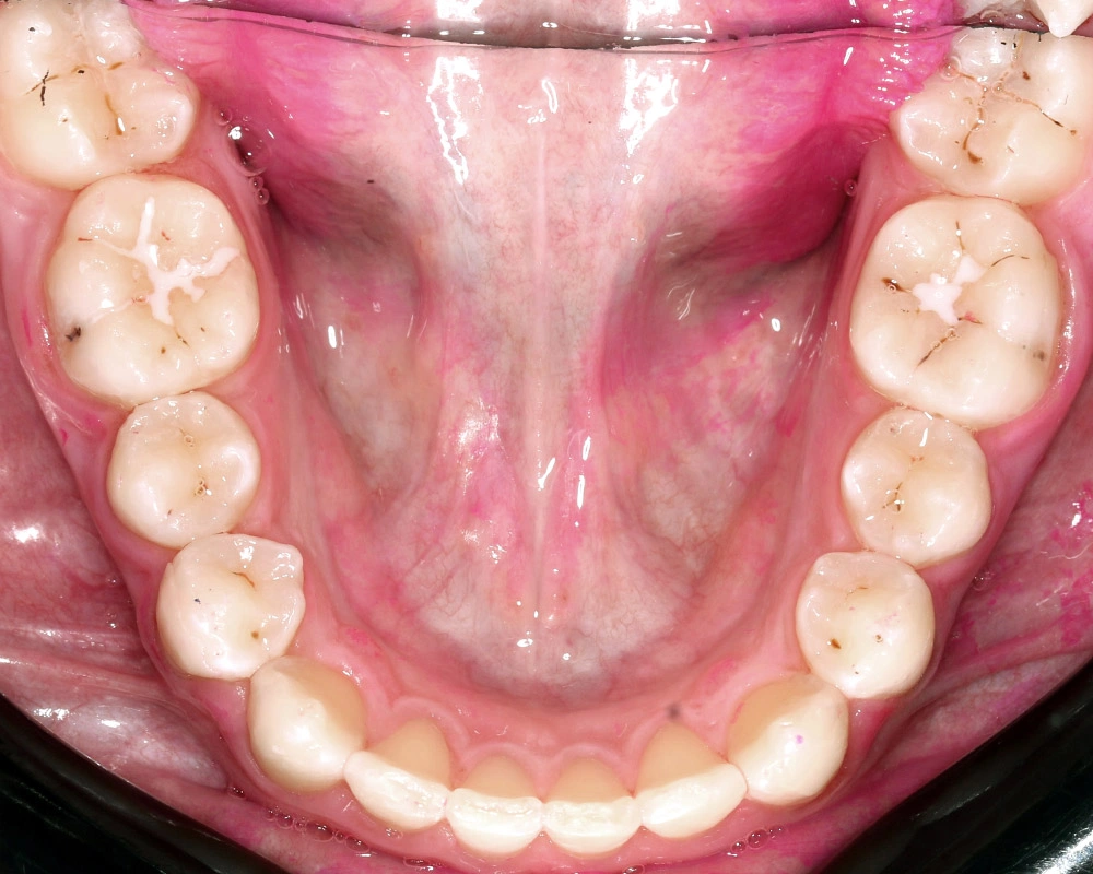 Глубокий прикус - Кейс 4 — нижняя челюсть после лечения