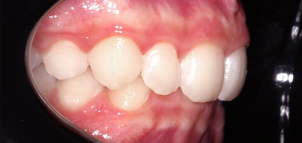 Глубокий прикус - Кейс 4 — боковой ракурс до лечения